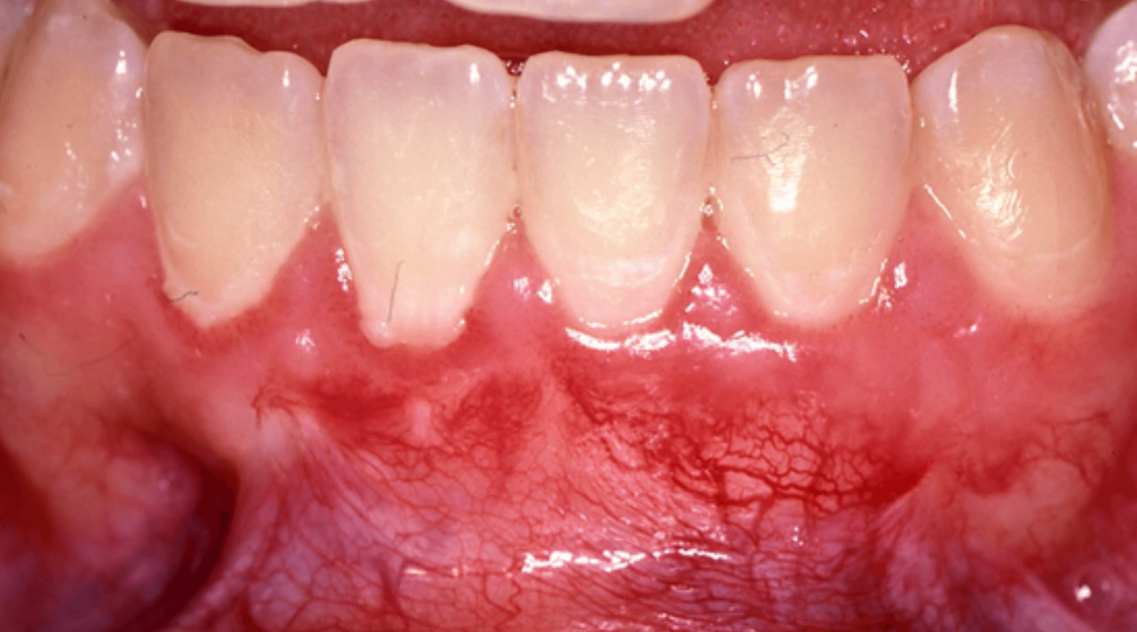 After Gum Grafting