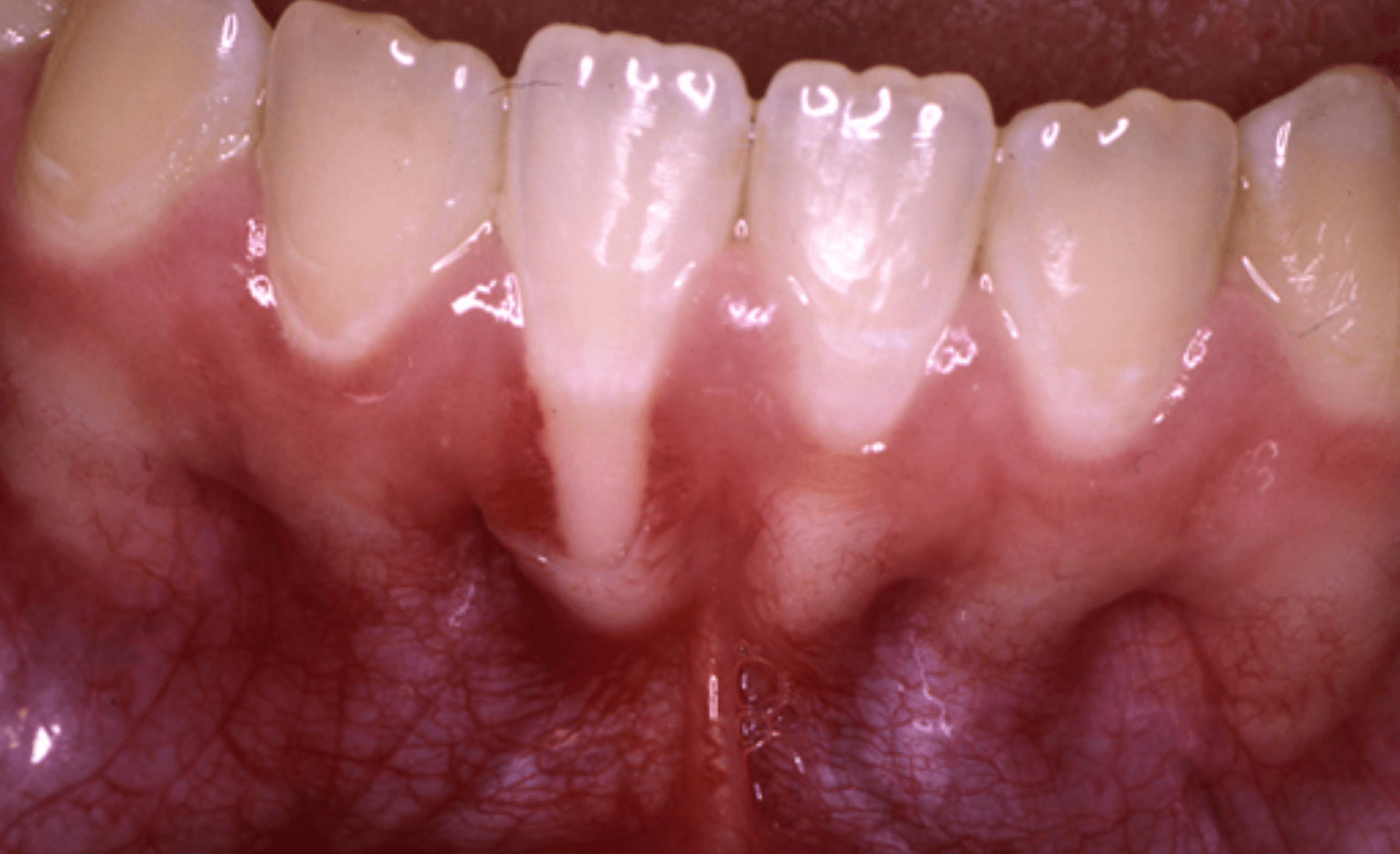 Before Gum Grafting