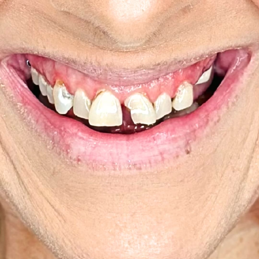 Before Teeth-in-a-Day