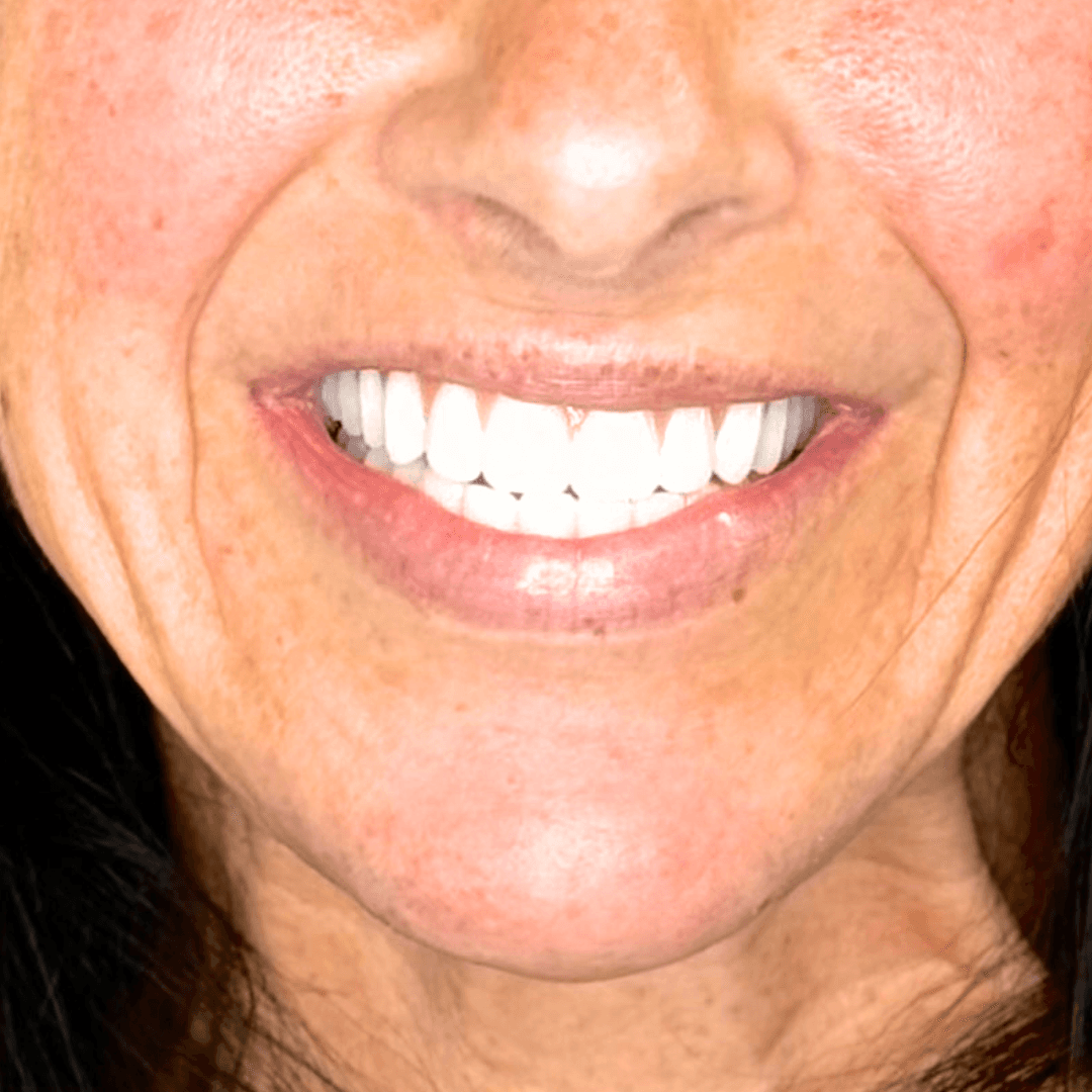 After Teeth-in-a-Day