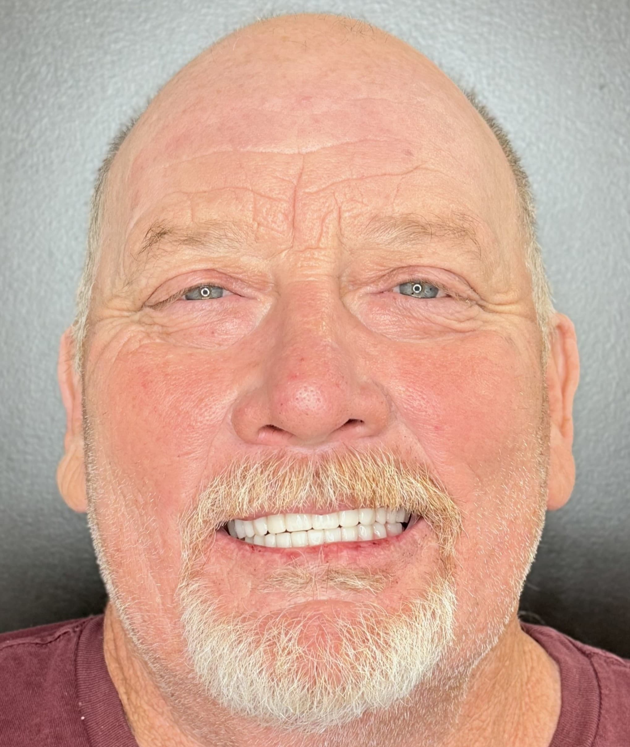 After Teeth-in-a-Day