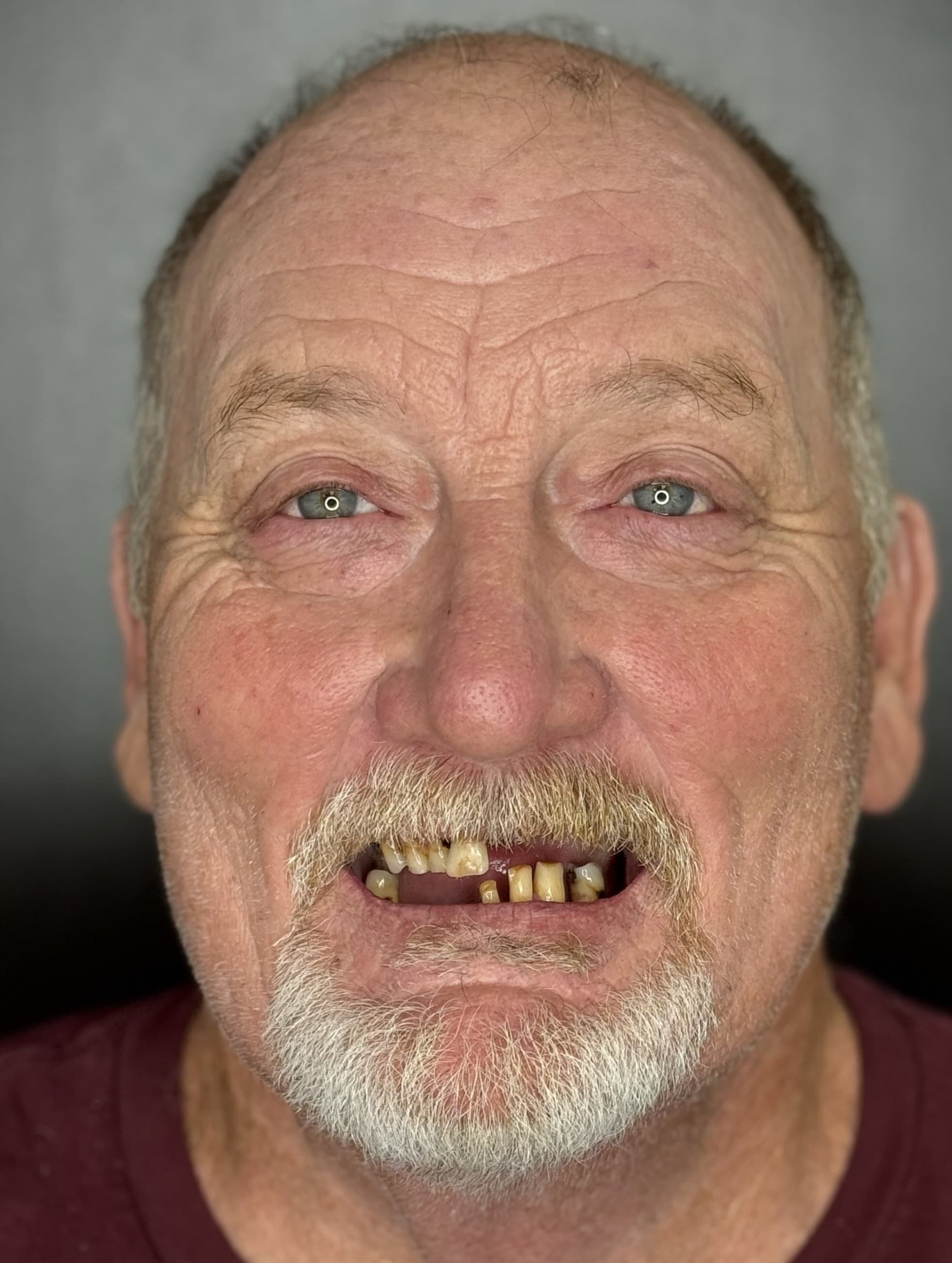 Before Teeth-in-a-Day