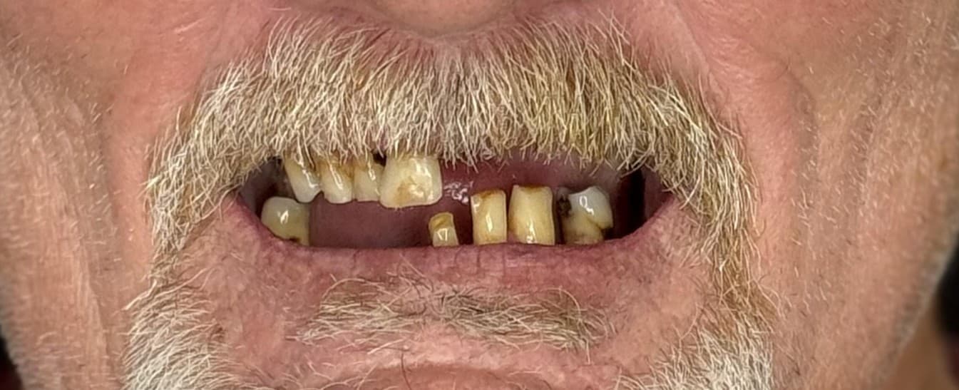 Before Teeth-in-a-Day