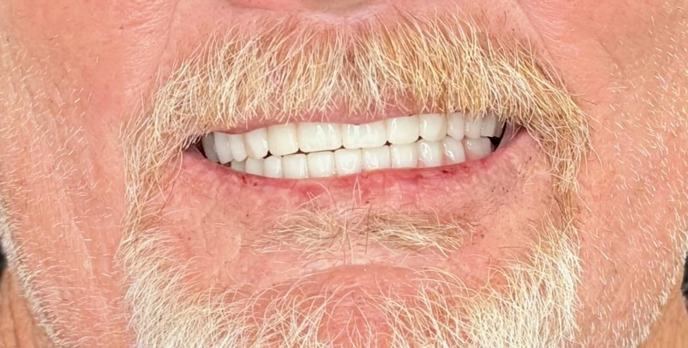 After Teeth-in-a-Day