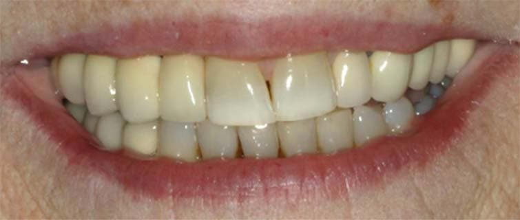 After Dental Implants