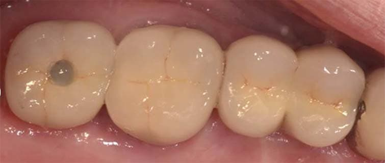 After Dental Implants