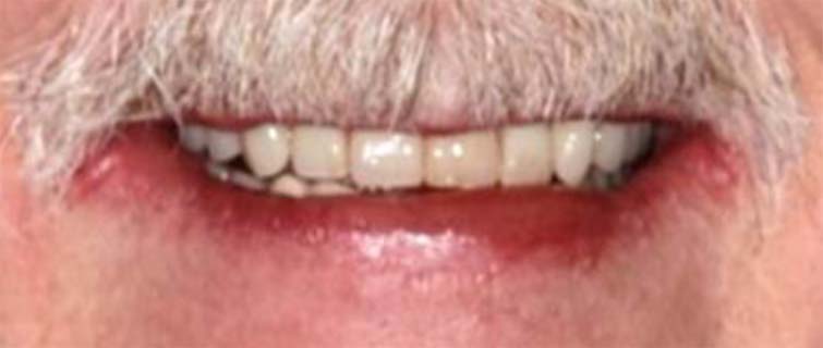 After Teeth-in-a-Day