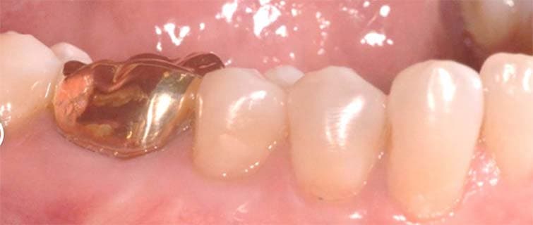 After Gum Grafting