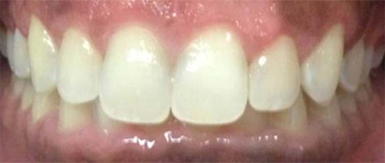 After Aesthetic Crown Lengthening