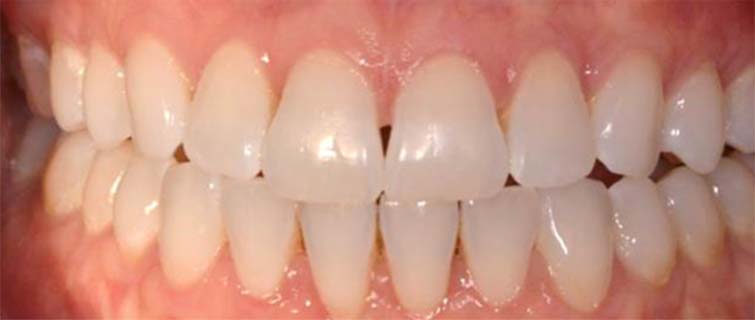 After Gum Grafting