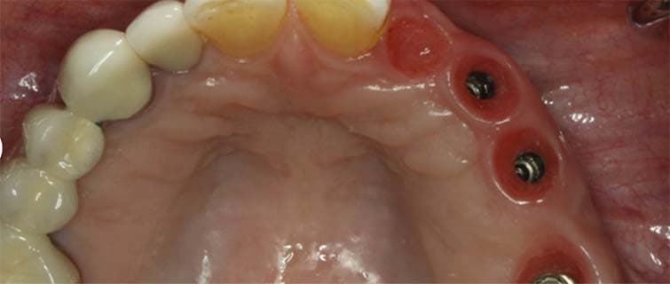 After Implant Shaping