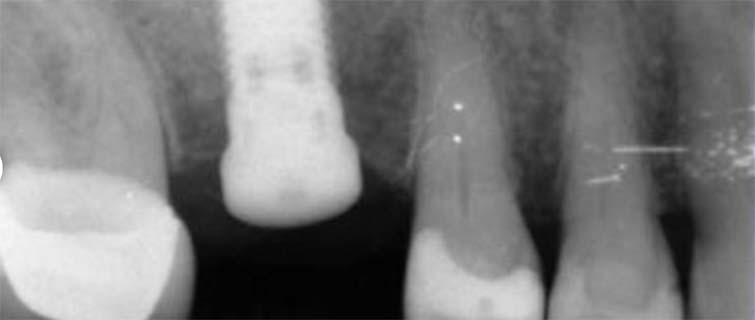 After Sinus Lift