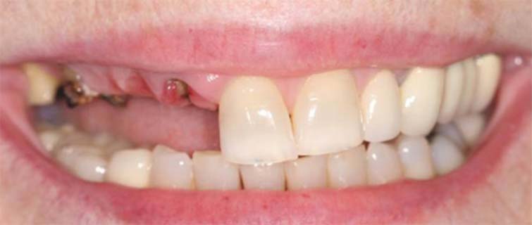 Before Dental Implants