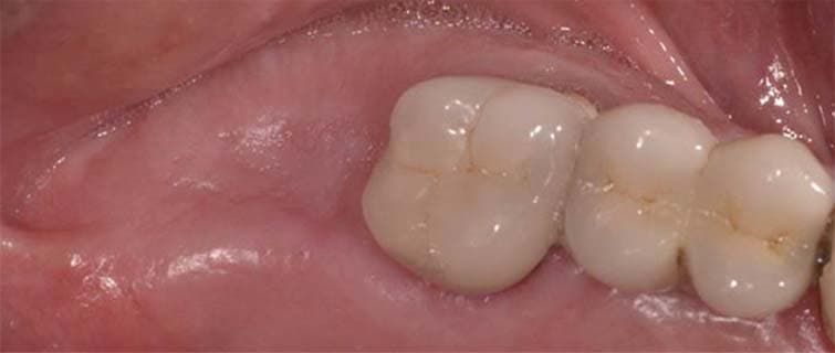 Before Dental Implants