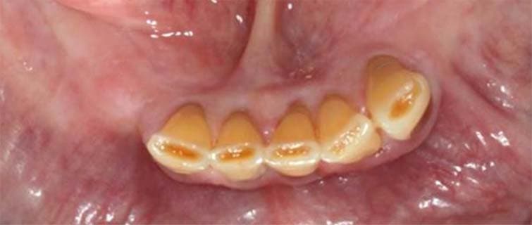 Before Teeth-in-a-Day