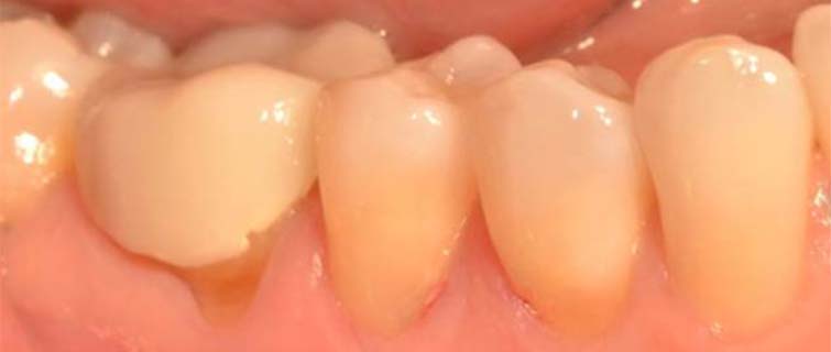 Before Gum Grafting