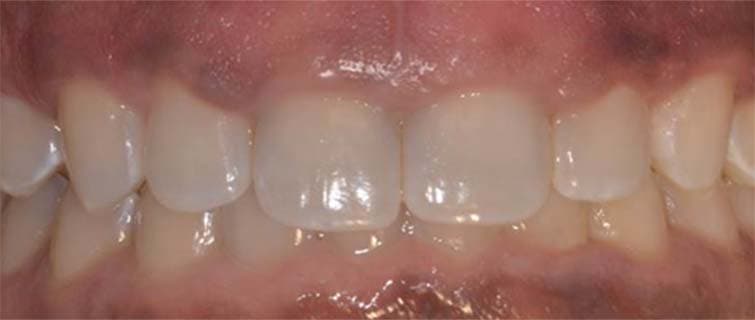 Before Aesthetic Crown Lengthening