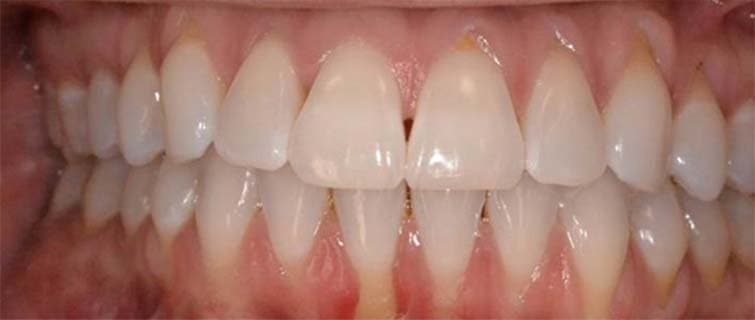 Before Gum Grafting
