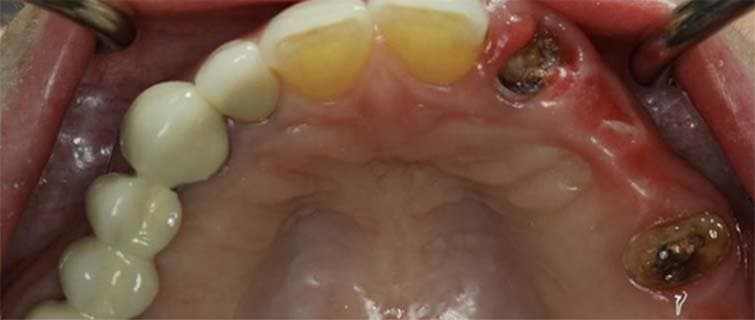 Before Implant Shaping