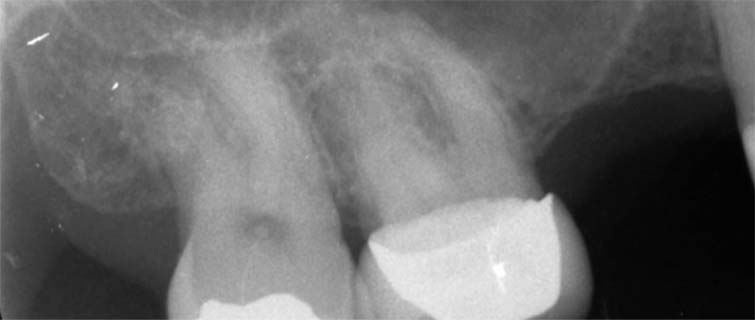 Before Sinus Lift