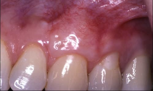 after Connective tissue grafting