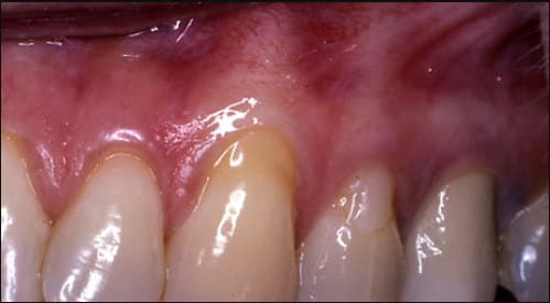 before Connective tissue grafting