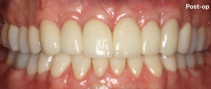 after Crown lengthening & rehabilitation