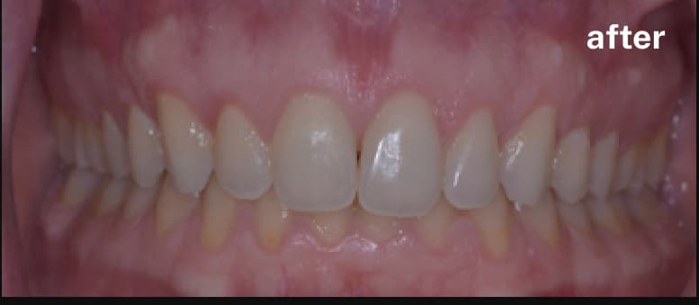 after Gingivectomy