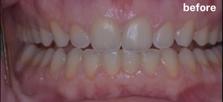 before Gingivectomy
