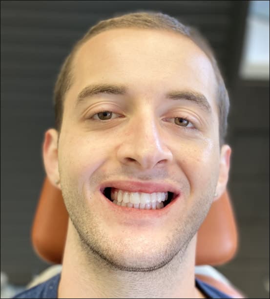 after Guided full-arch implant treatment