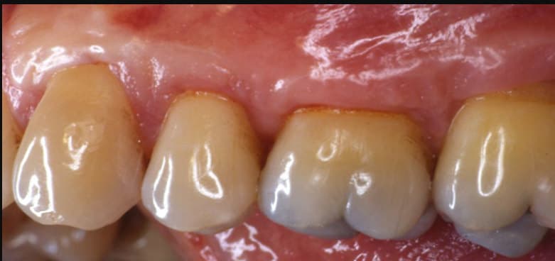 after Connective tissue grafting