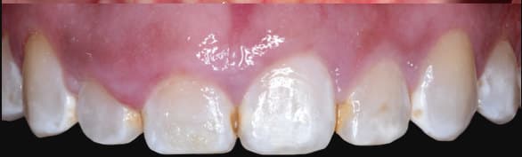 before Full-arch crown lengthening