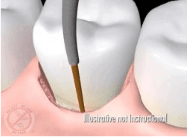 PerioLase MVP-7 laser used in LANAP treatment for gum disease