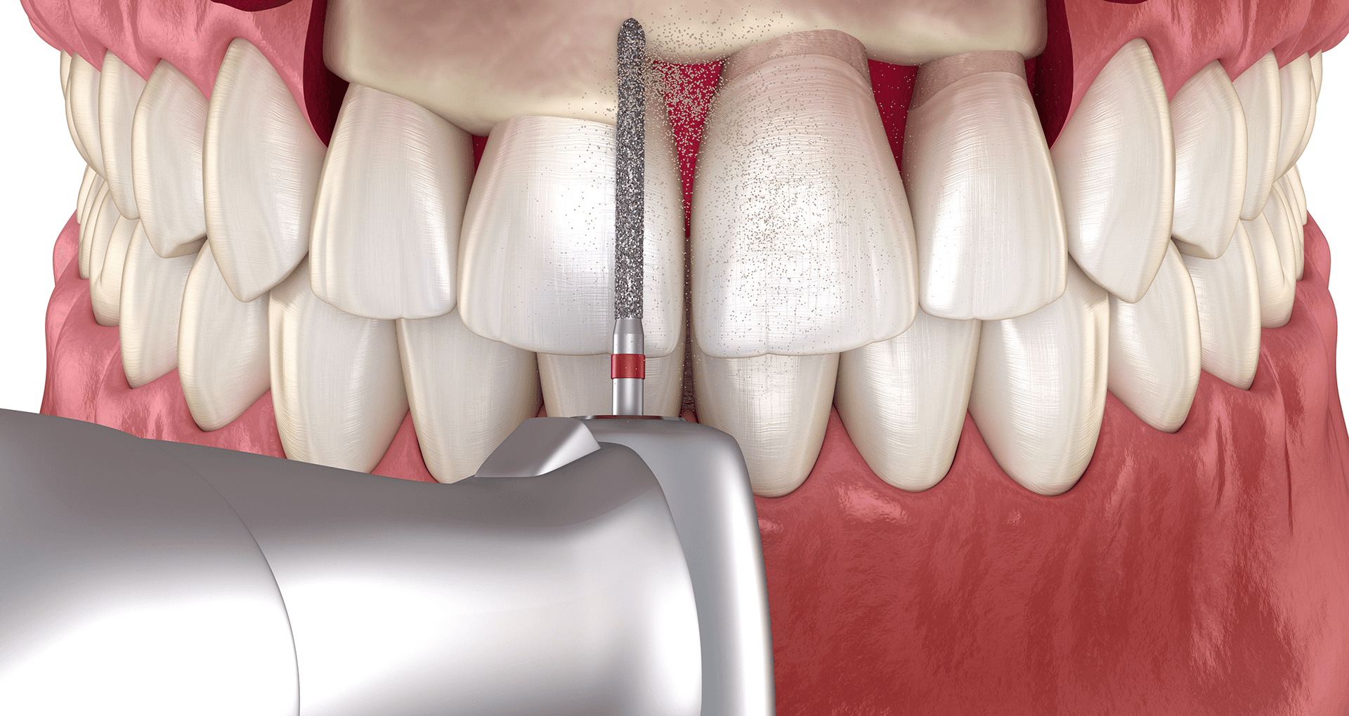 Before and after aesthetic crown lengthening for gummy smile correction