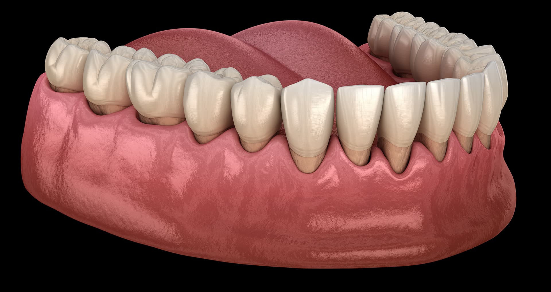 Stages of gum disease from healthy gums to advanced periodontitis