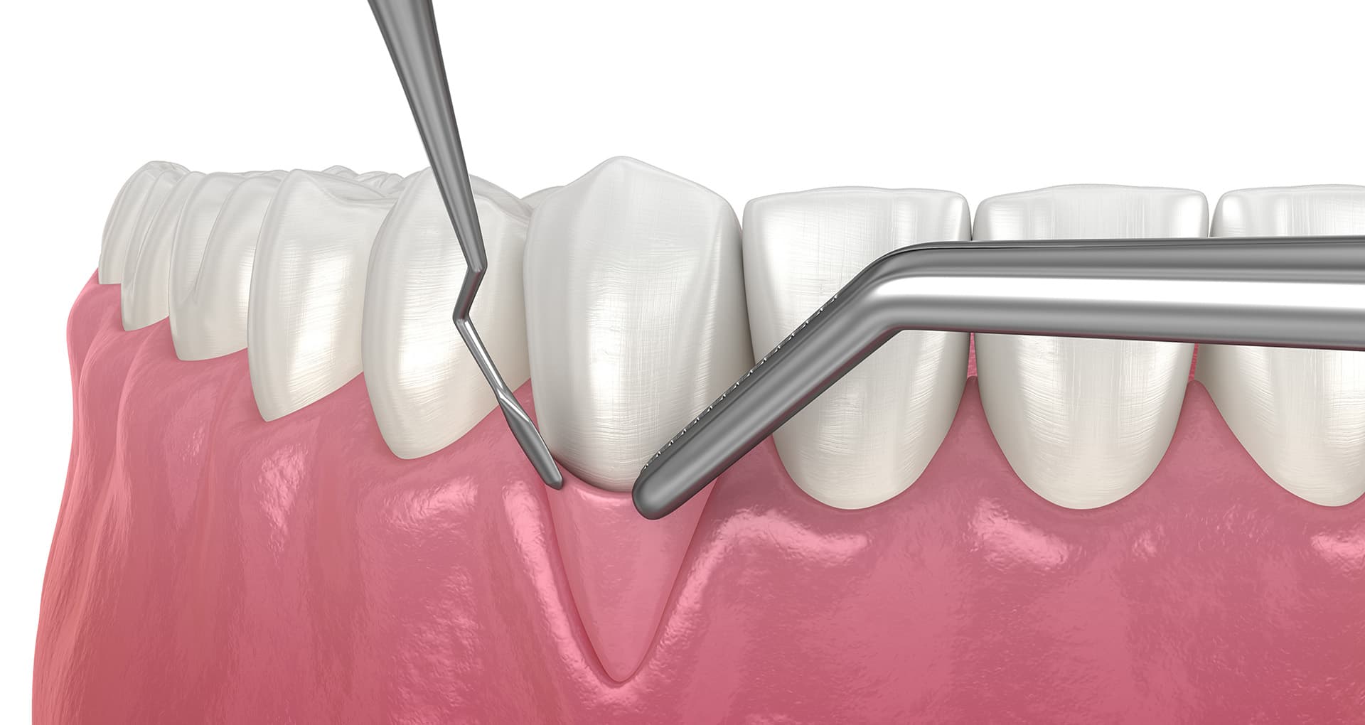 Gum Grafting & Recession Treatment
