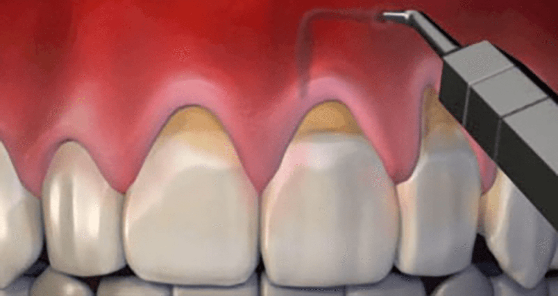 Pinhole Surgical Technique for minimally invasive gum recession treatment