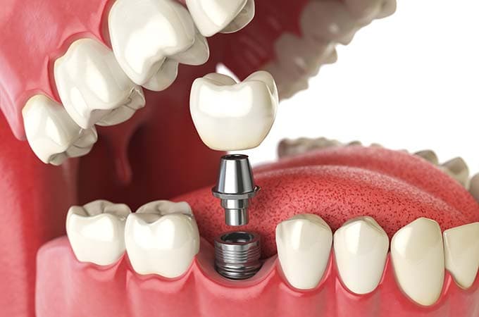 Bone Grafting