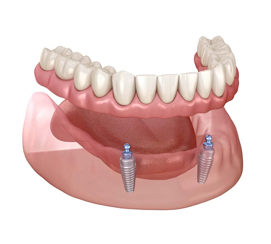 Implant-Supported Dentures